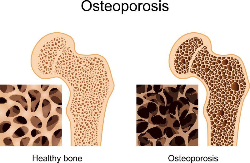ESPORT I SALUT: OSTEOPOROSI